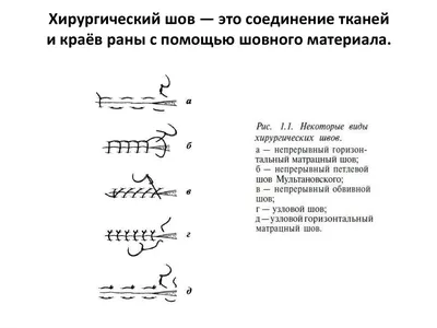 Хирургические швы: виды и способы наложения - все, что нужно знать