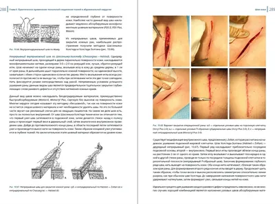 Хирургический шов | Пикабу