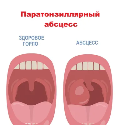 Лечение тонзиллита в Москве лазером - цена от 2500 руб