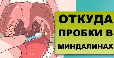 Лечение хронического тонзиллита в домашних условиях: эффективные методы и  средства