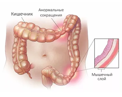 Рак кишечника: симптомы, признаки, диагностика и лечение