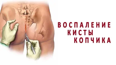 Киста копчика – симптомы пилонидальной болезни и лечение в Москве