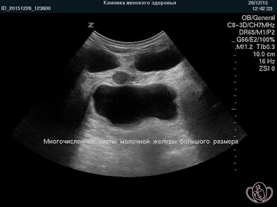 Киста молочной железы: ФОТО и успешное ЛЕЧЕНИЕ | Курортная клиника женского  здоровья