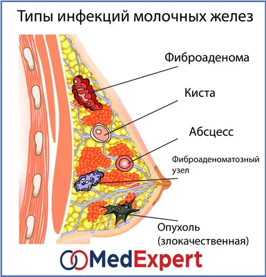 КИСТЫ МОЛОЧНОЙ ЖЕЛЕЗЫ | MedExpert