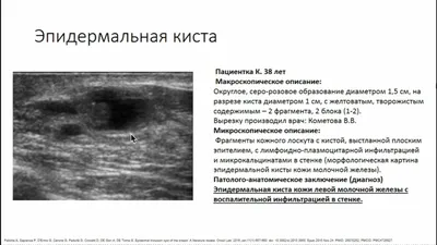 Доктор Рябчиков Д.А. - Чаще всего кисты молочных желез обнаруживаются при  пальпации либо на УЗИ. Пациенты, как правило, замечают неладное во время  самостоятельного осмотра. Кисты могут длительное время протекать  бессимптомно. Если киста