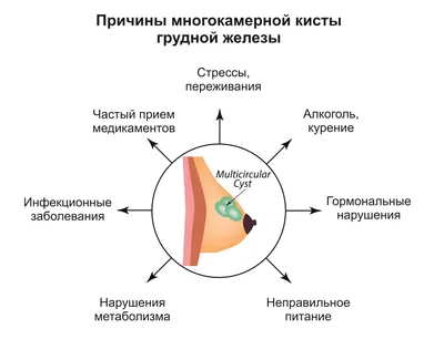 Киста молочной (грудной) железы - лечение кисты в груди у женщин