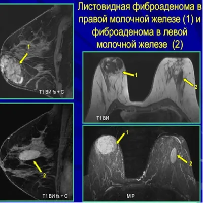 Кисты молочной железы на УЗИ