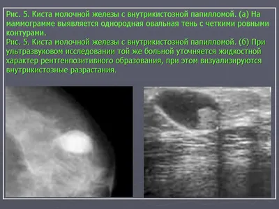 Лечение своевременно обнаруженного рака молочной железы - история лечения в  Ильинской больнице.