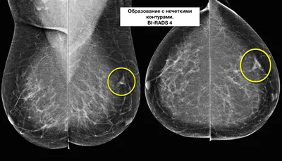 Лечение опухолей и опухолеподобных процессов в СПб больнице РАН на  маммологическом отделении