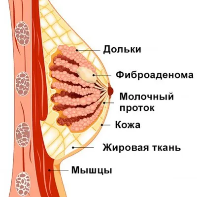 Киста молочной железы - лечение в СПб, причины, симптомы, фото