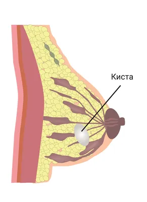 Киста молочной железы Что это, как образуется, чем лечить? | Семейная Бьюти  | Дзен