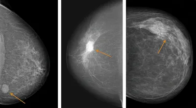 Расшифровка маммографии, Bi-RADS, пересмотр маммографии, описать маммографию