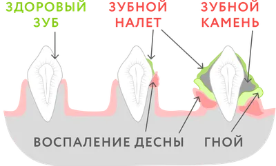 Лимфоцитарно-плазмоцитарный стоматит-гингивит у кошек |