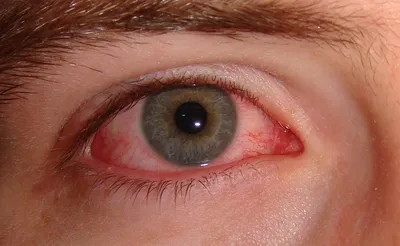 Киста конъюнктивы: причины, дермоидная и ретенционная на глазном яблоке,  лечение МКБ у взрослых и ребенка