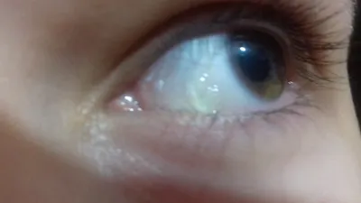 Киста конъюнктивы глаза: ретенционная, дермоидная, лечение и капли