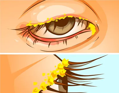 Киста глаза - причины и признаки кисты глаза