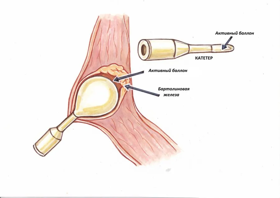 Бартолинит ворд катетер. Word катетер бартолиновой железы. Марсупиализация кисты бартолиновой железы. Киста бартолиновой желез.