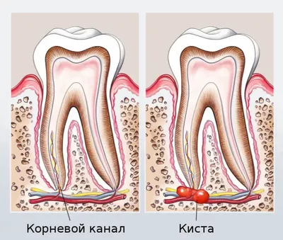 Киста зуба – чем опасна, симптомы, как выглядит