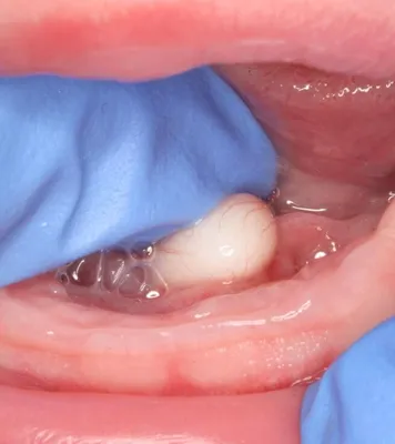 Дермоидная киста: обзор клинического случая - parodont.pro