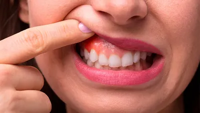 Фолликулярные кисты зубов и их лечение - \"Фортуна\"