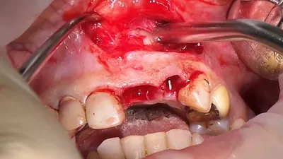 Киста после удаления зуба — симптомы и лечение