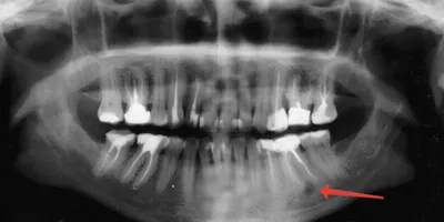 Киста зуба в Сибае, лечение и удаление | Стоматология Риадент