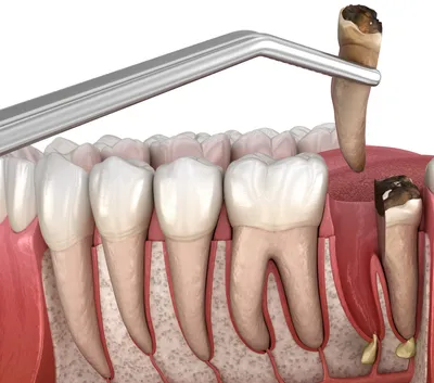 Киста зуба: основные причины и способы лечения — Клиника Лукашука