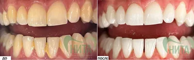 Лечение зуба после давней травмы - детская стомалогия Nikadent Family