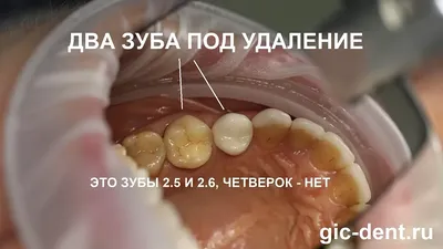 Картина хронического периодонтита | Второе мнение