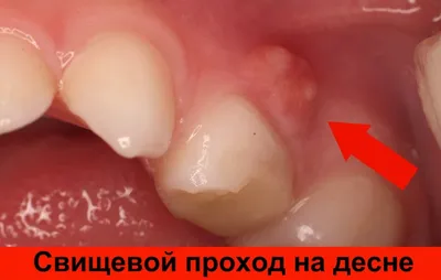 Киста зуба – чем опасна, симптомы, как выглядит