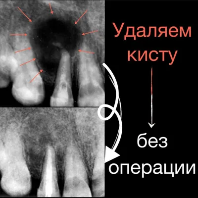 Киста зуба - что это, причины кисты зуба, стадии, симптомы, виды и лечение  кисты