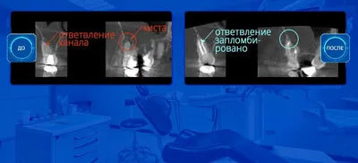 Лечение кисты зуба без операции в Санкт-Петербурге - клиника \"Галерея  Улыбок\"
