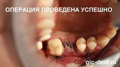 Киста зуба: причины, симптомы и последствия - Underson Clinic