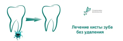 Удаление кисты зуба в Минске, цена в стоматологии