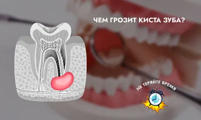 Киста зуба? - Стоматология - Форум стоматологов (стомотологический форум) -  Профессиональный стоматологический портал (сайт) «Клуб стоматологов»