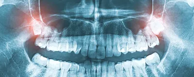 Алгоритм внутриротового лучевого исследования и описания снимков зубов -  DENTALMAGAZINE.RU