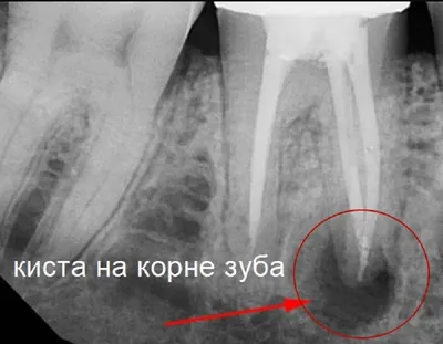 Удаление кисты зуба - стоимость услуги Резекция верхушки корня зуба в  Киеве, Удаление кисты зуба - цена в стоматологии lipinskii.com.ua