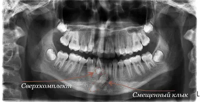 Киста челюсти - виды, причины, симптомы, признаки, диагностика, лечение  (операция по удалению)
