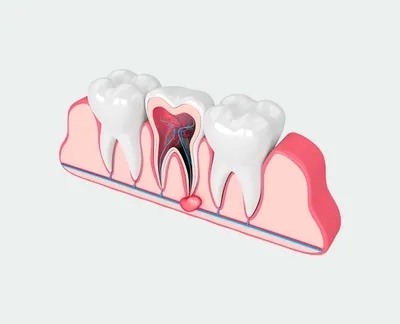 Киста зуба - что это, причины кисты зуба, стадии, симптомы, виды и лечение  кисты
