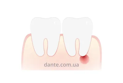 Киста зуба: причины, симптомы, правильное лечение — D.Ante