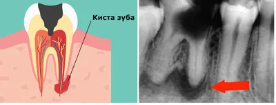 Опасна ли киста зуба - Стоматология Северное Бутово Делия только  качественные услуги