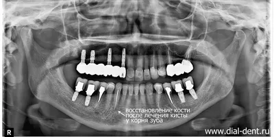 Киста зуба, обнаруженная на компьютерной томограмме зубов