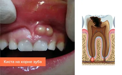 Лечение кисты зуба лазером – отзывы, преимущества, показания