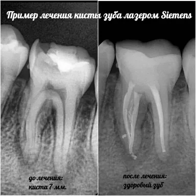 Лечение кисты зуба лазером. Современный и эффективный метод