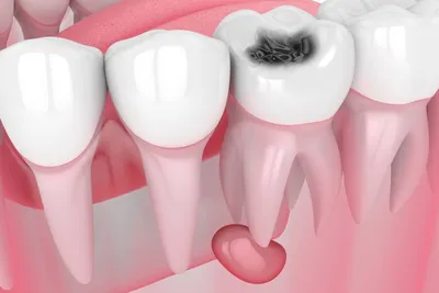 Киста зуба: как выглядит, как проявляется. 🦷 Киста корня зуба: как быть  после кисты зуба