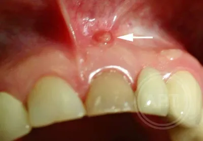 Удаление кисты зуба в челюсти, на корне зуба, в зубном канале в Одинцово