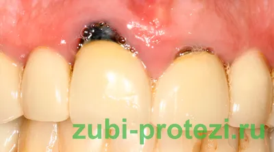 Киста корня зуба под коронкой – почему возникает патология, как ее  распознают и лечат