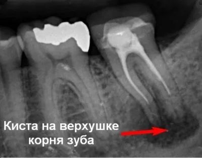 Лечение кисты на корне зуба【Цена в Москве】