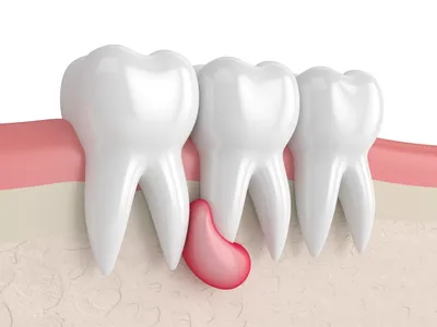 Киста зуба - лечить или удалять
