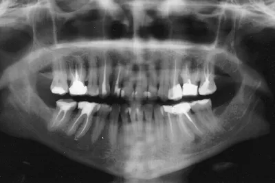 Киста зуба, симптомы. Как выглядит киста зуба на снимке фото? Последствия  кисты в зубе